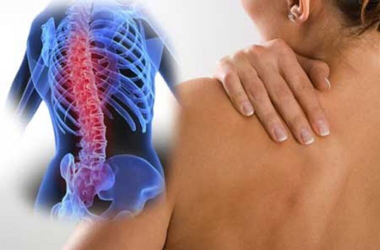 Με την οστεοχονδρωσία, ο πόνος μπορεί να ακτινοβολεί σε μακρινά μέρη του σώματος