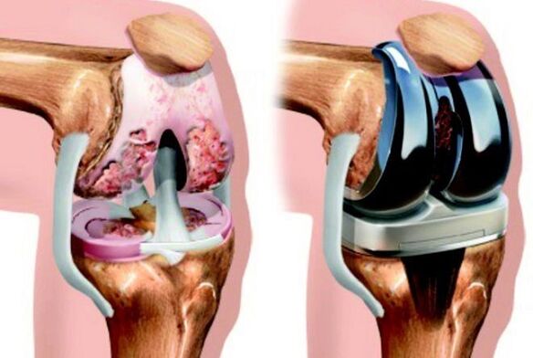 πριν και μετά την αρθροπάθεια της άρθρωσης του γόνατος για αρθροπάθεια